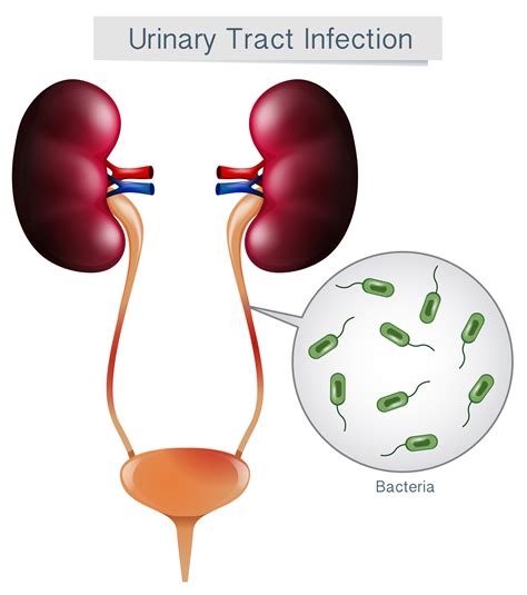 infección de vías urinarias